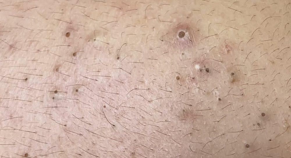 Practical Tips to Get Rid of Blackheads 2025