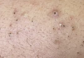 Practical Tips to Get Rid of Blackheads 2025