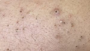 Practical Tips to Get Rid of Blackheads 2025 (Video Below)