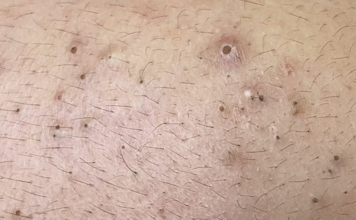 Practical Tips to Get Rid of Blackheads 2025