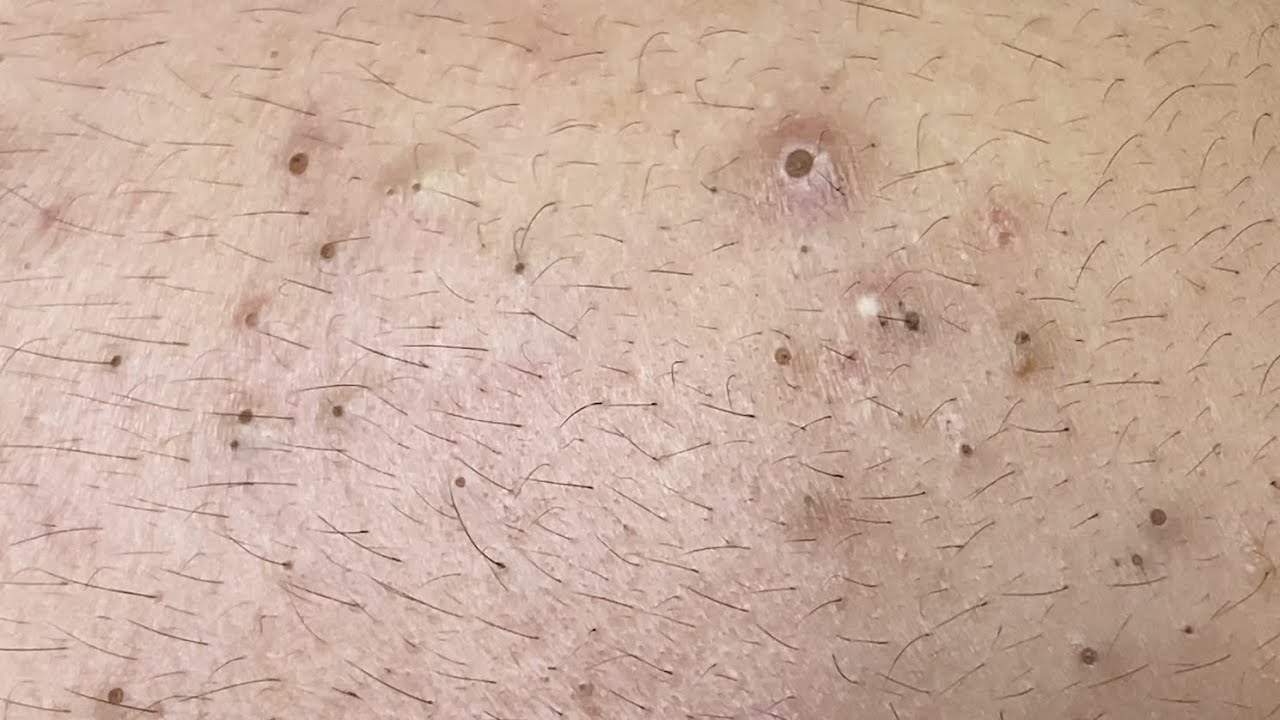 Practical Tips to Get Rid of Blackheads 2025
