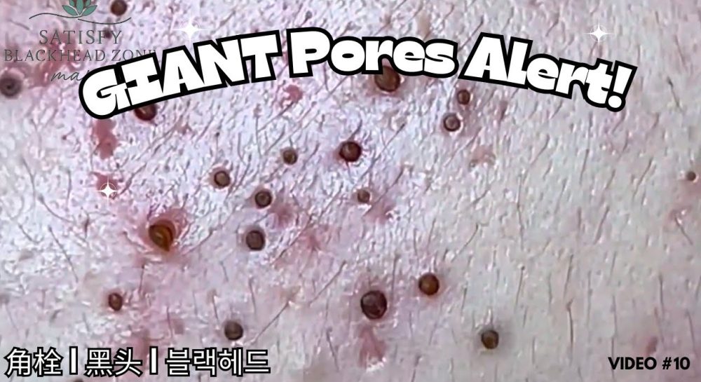 4 Professional Treatments To Remove Blackheads