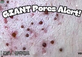 4 Professional Treatments To Remove Blackheads