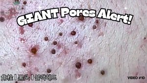 4 Professional Treatments To Remove Blackheads (Video Below)