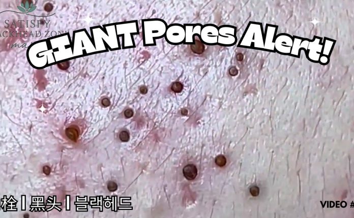 4 Professional Treatments To Remove Blackheads